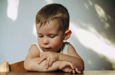 Understanding and Managing Eczema in Children