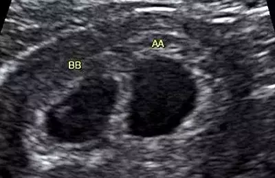A Journey Through Twin Pregnancy: Ultrasound Milestones